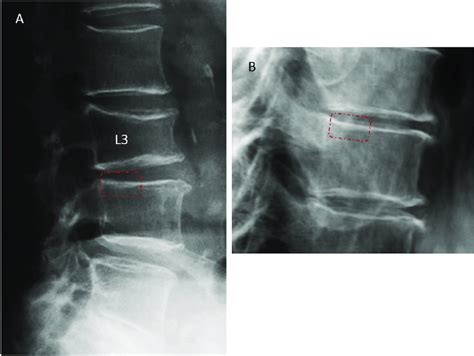 (A) L3 upper and lower endplates fracture and SQ-VD grade 2 ...