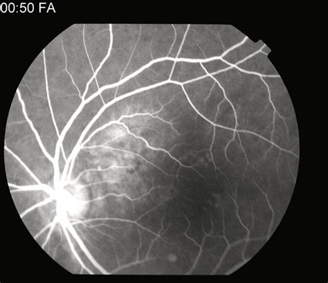 Choroidal Hemangioma - Retina Image Bank