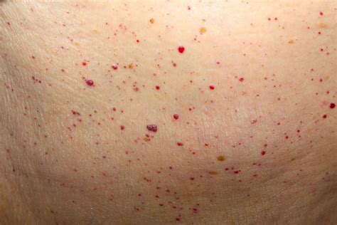 6 Bizarre Skin Spots Explained - Integrity Paramedical Skin Practitioners