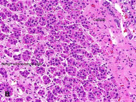 Adrenal Cortical Adenoma Histology