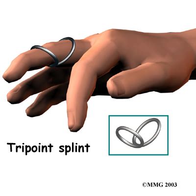 Physical or Occupational Therapy in Cleveland for Swan Neck Deformity ...