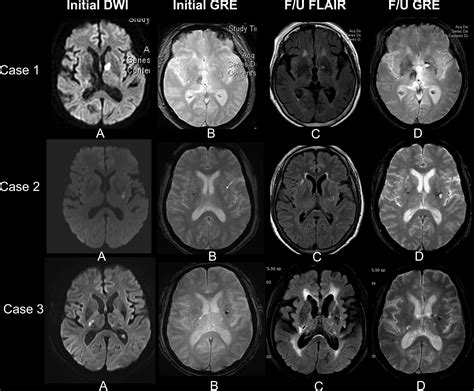 Intracerebral Hemorrhage Mri