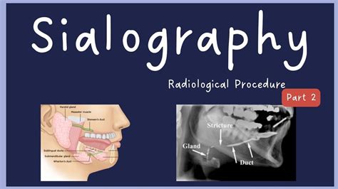 Sialography Complete Procedure (Part 2) - YouTube