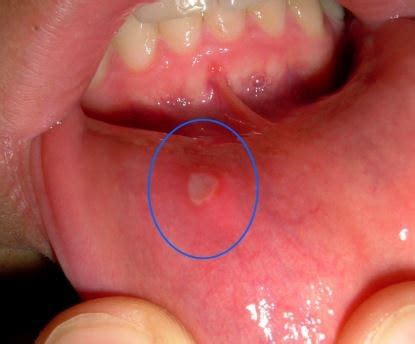 Aphthous Ulcers - Treatment, Pictures, Causes, Types, Symptoms