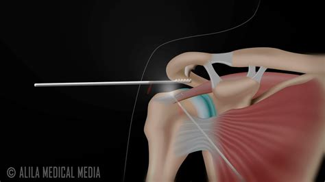 Subacromial Bursitis - Carolina Regional Orthopedics