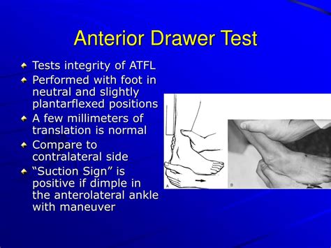 PPT - Everything You Ever Wanted to Know About Ankle Sprains PowerPoint ...