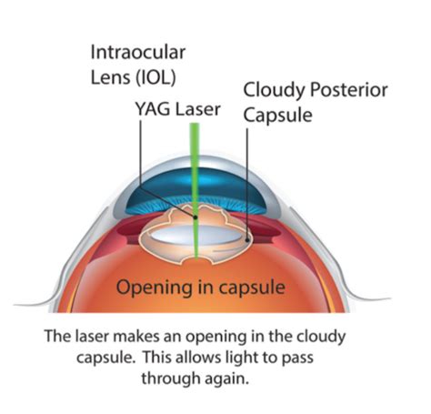 Posterior Capsular Opacification Relief in , IL - Chittick Eye Care