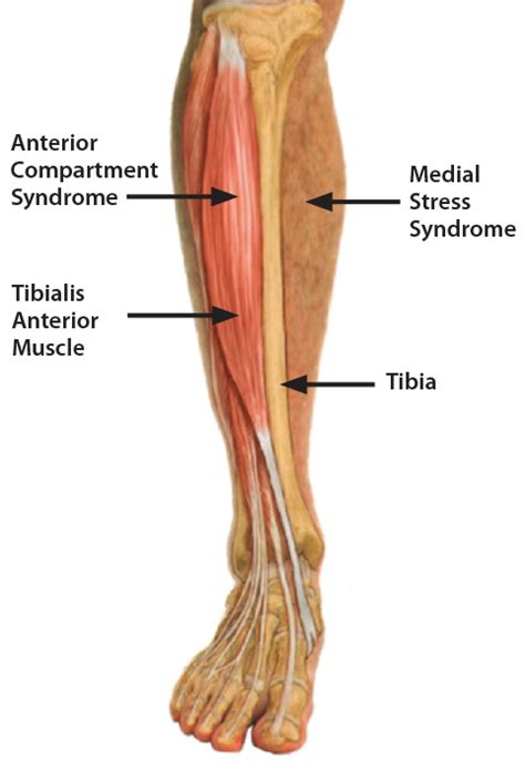 Shin Splints – ICB Medical