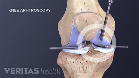 Types of Knee Surgery for Arthritis Treatment