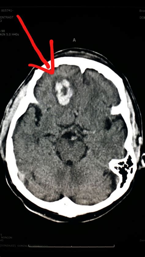 Brain Cyst Ct Scan