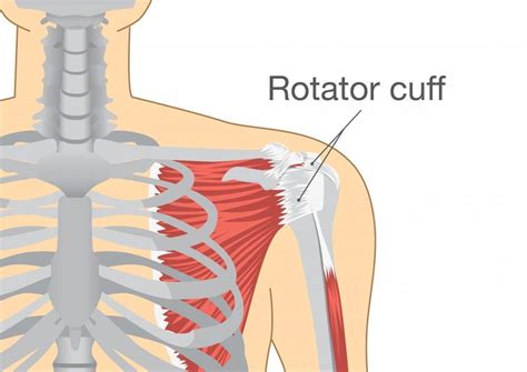 5 Tips for Recovery After a Rotator Cuff Injury: ORTHOPAEDIC SURGICAL ...