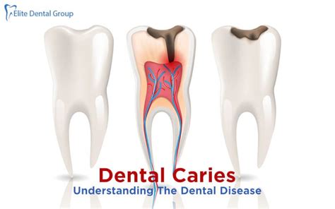 DENTAL CARIES- CAUSES, SYMPTOMS, TYPES AND TREATMENT | by Elite Dental ...