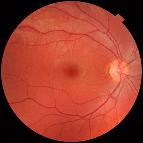 Fundus photography - Wikipedia