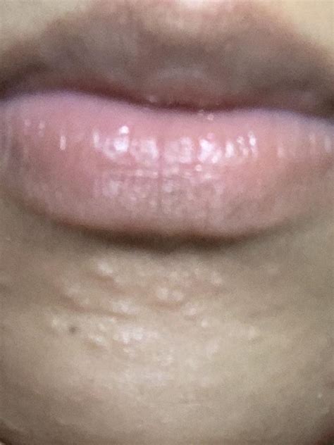 How do I get rid of these acne scars in my chin? : r/AcneScars