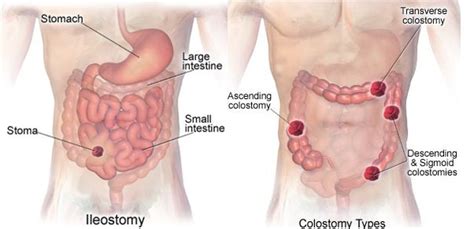 ileostomy vs colostomy | Ileostomy, Colostomy, Ostomy