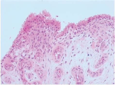 Histological view of the synovium demonstrating a react | Open-i