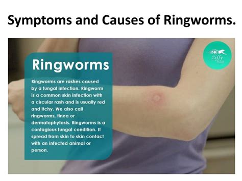 Symptoms and Causes of Ringworms. by ziffytech07 - Issuu