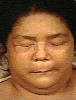 Myxedema Coma - Treatment, Symptoms, Causes, Diagnosis