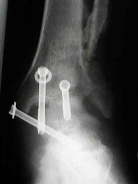 Ankle Arthrodesis - Discussion : Wheeless' Textbook of Orthopaedics