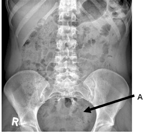 Sacral Agenesis X Ray