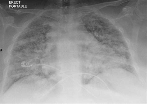 171Lu Acute Inhalational Crack Injury | Lungs