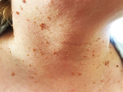 12 Bumps On Your Skin That Are Totally Normal—And You Shouldn't Pop ...