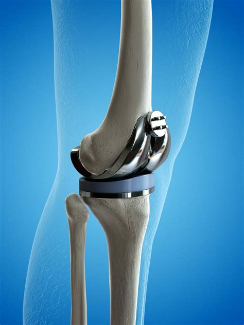 What exercises should I do immediately after my Knee Replacement ...