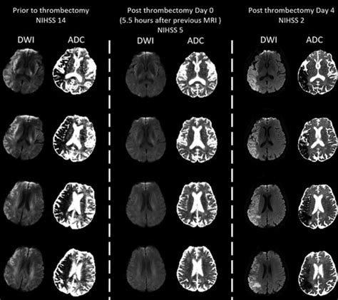 Transient Complete Reversal of Large Area of Restricted Diffusion Seen ...