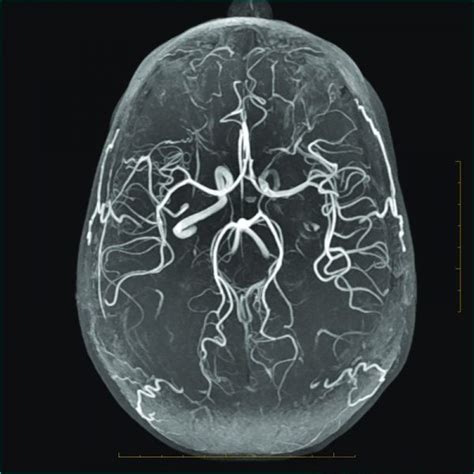 MR Angiography (MRA) - Insight Medical Imaging