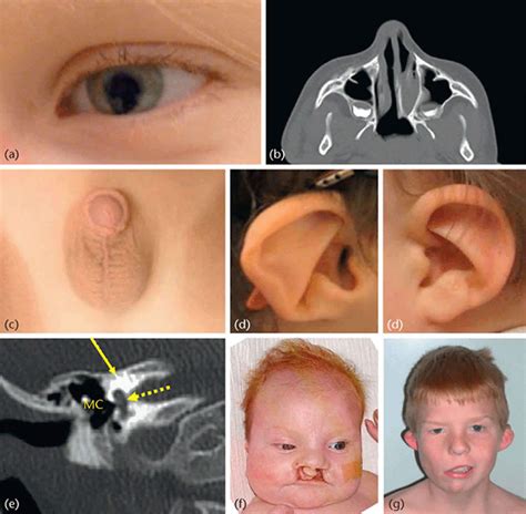 CHARGE syndrome causes, symptoms, diagnosis, life expectancy & treatment