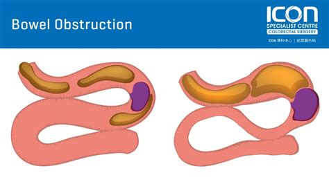 Bowel obstruction — Icon Specialist Centre