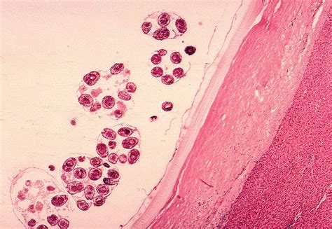 Free picture: histopathology, echinococcus, granulosus, hydatid, cyst ...