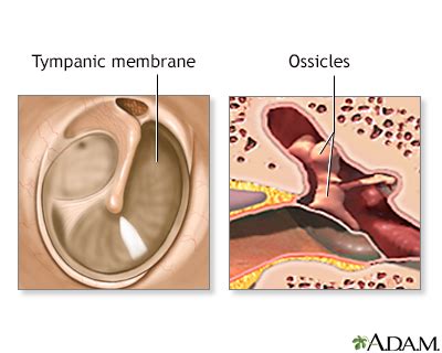 How Long Will Fluid Drain From Ruptured Eardrum - Best Drain Photos ...