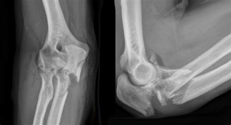 Complex Elbow Fracture | Arm Docs