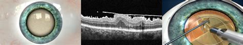 Combined Surgery for Epiretinal Membrane - Retina Doctor