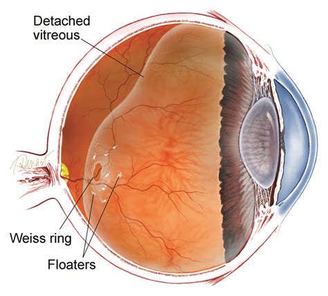 Vitrectomy for Floaters | Retina Specialists of North Alabama, LLC