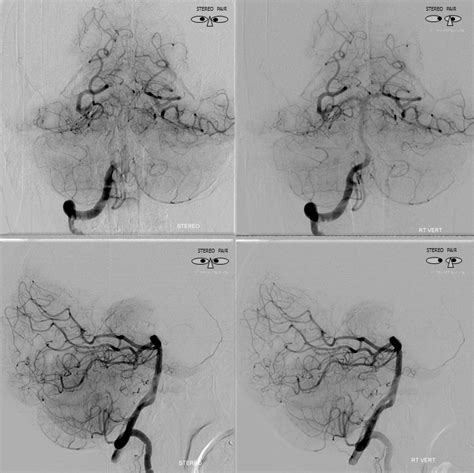 Middle Meningeal Artery | neuroangio.org