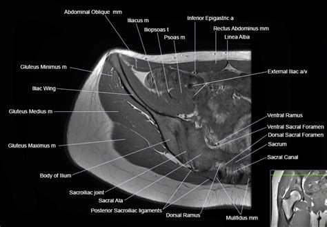 Hip Joint Anatomy Mri