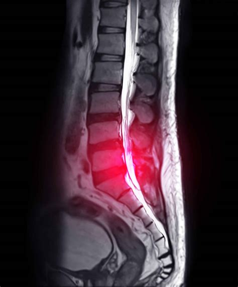 Modic Changes of the Spine: Meaning and Significance - Spine Info