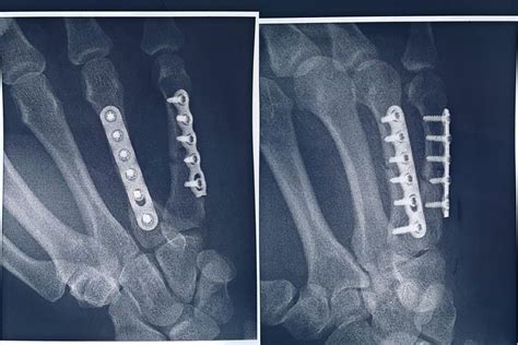 ORIF surgery on my 4th + 5th metacarpals : r/Radiology