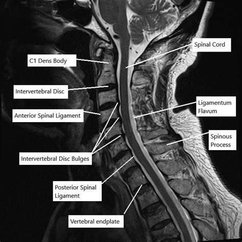 Mri Cervical Spine Lumbar Spine Mri Scan Images Spinal Stenosis ...