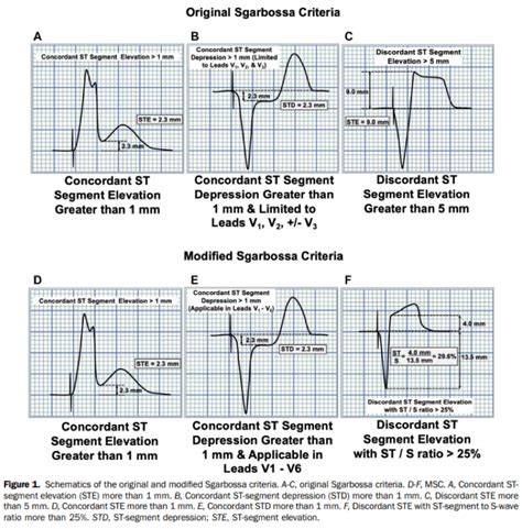 Modified Sgarbossa Criteria for Ventricular Paced Rhythms - JournalFeed