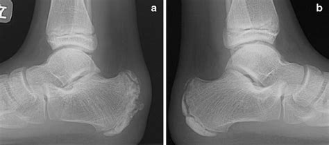 Calcaneal apophyseal avulsion fracture | SpringerLink