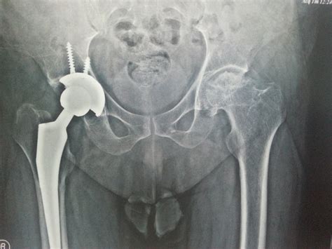 Femur Bone Fracture