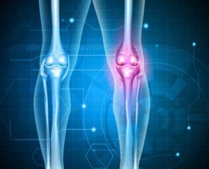 Stem Cell Therapy for Treating Arthritis - Sarasota Orthopedic Surgeon ...