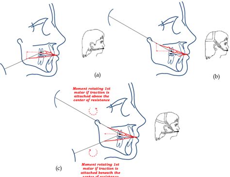 Headgear-force vectors depending on position of external traction: a ...