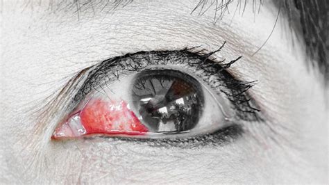 Eye bleeding: Types, causes, treatment, and seeking help