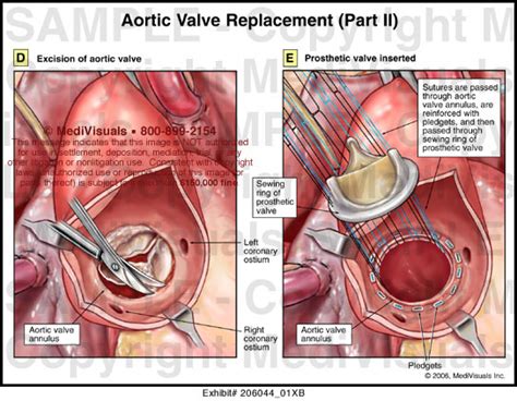 Aortic Valve Replacement (Part II) Medical Illustration Medivisuals