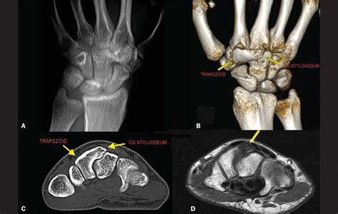 A: Digital X-ray showing a lack of definition of the joint space ...