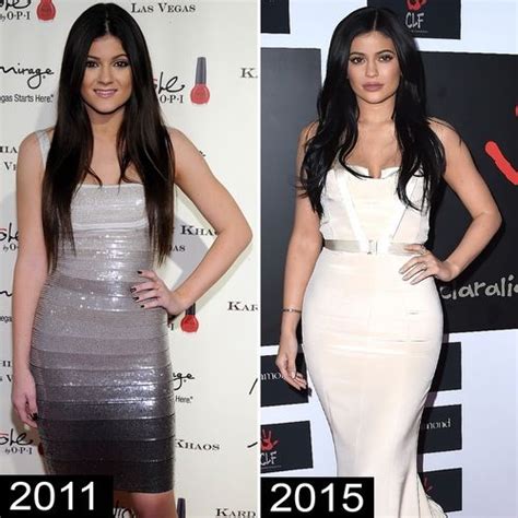 Kylie Jenner’s Plastic Surgeon Reveals All: See Her Shocking ...